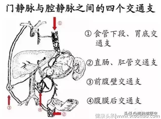 肝硬化会导致痔疮引起出血吗？