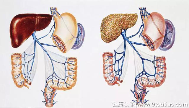 为什么肝硬化患者需要进行胃镜检查？