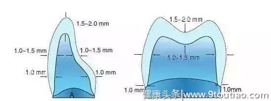 为什么医生总是推荐做全瓷牙？