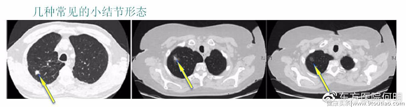 肺部结节竟是肺癌吗？这到底是真的吗？