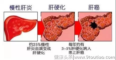 肝脏慢慢变“硬”真的无迹可查吗？