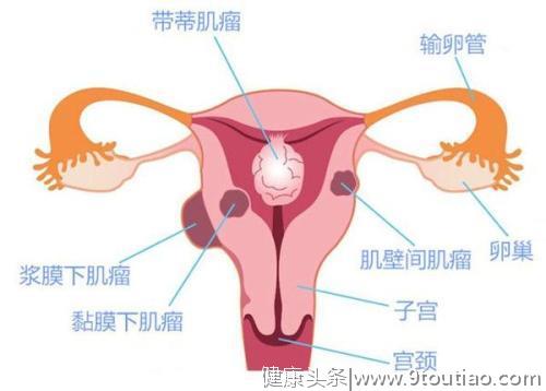 子宫肌瘤一定要切除？关于子宫肌瘤的5大疑惑，需要了解一下