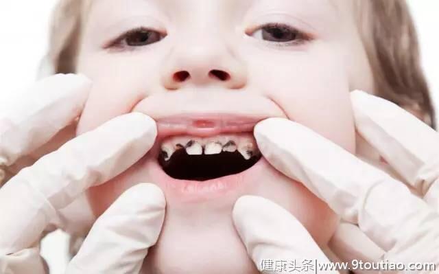 儿童蛀牙疼怎么办？