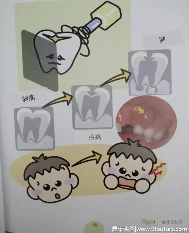 蛀牙不痛，要不要补牙？