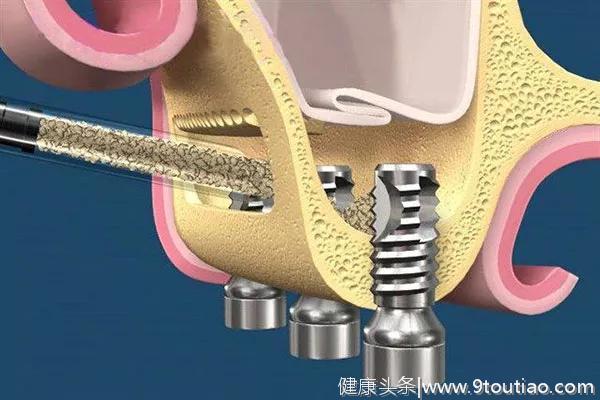 种了牙还吸烟？这个习惯很可能导致你新牙报废