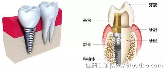 种了牙还吸烟？这个习惯很可能导致你新牙报废