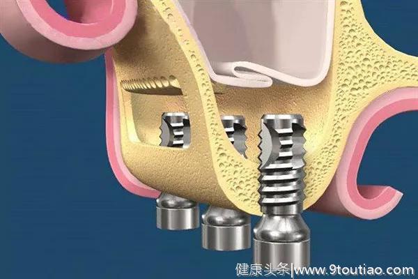 种了牙还吸烟？这个习惯很可能导致你新牙报废