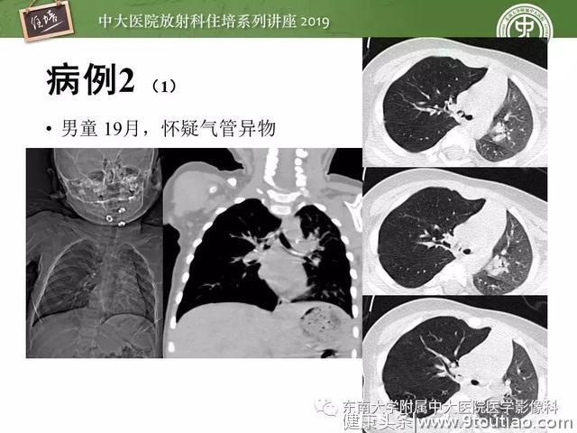 呼吸系统急症影像解读