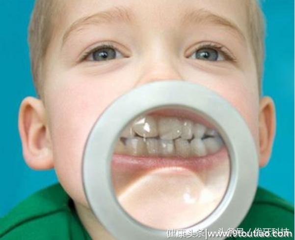 儿童矫正的最佳时间，儿童牙齿矫正的最佳年龄