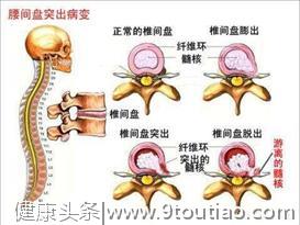 饮酒对腰间盘突出有利还是有害？听听骨科医生怎么说