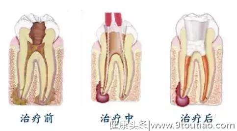 戴个牙冠多么重要！国宝大熊猫做根管治疗补了牙，还戴上了牙套