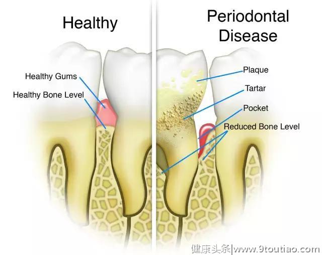 老了才会得牙周炎？不一定！年轻人要当心了
