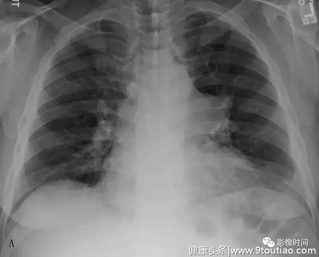 呼吸系统典型征象之纵隔、肺门区征象