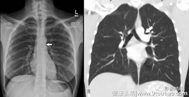 呼吸系统典型征象之纵隔、肺门区征象