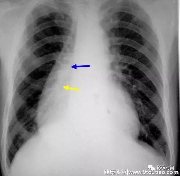 呼吸系统典型征象之纵隔、肺门区征象