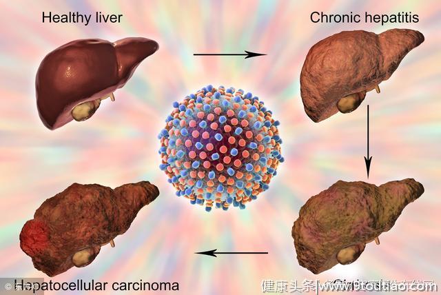 慢性肝炎或会发展成肝癌！医生：这一肝炎可治愈却少有人知