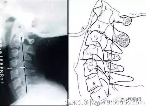 详细的颈椎X线解剖+解读