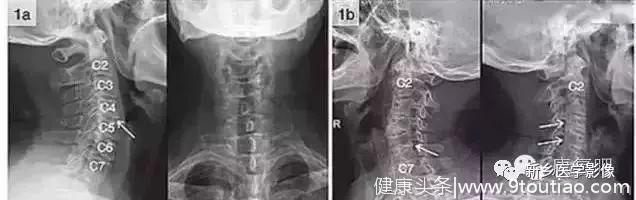 详细的颈椎X线解剖+解读