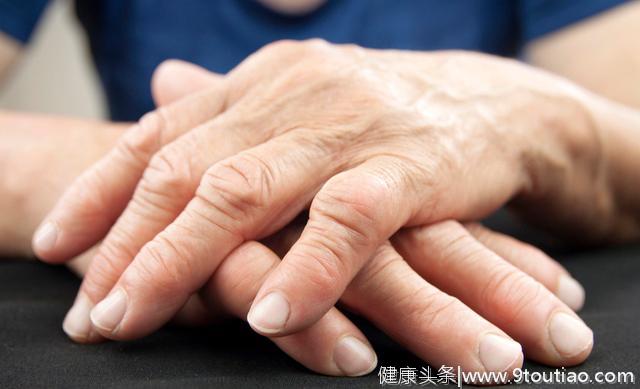 类风湿关节炎新药「巴瑞替尼」在中国上市！类风湿关节炎患者福音