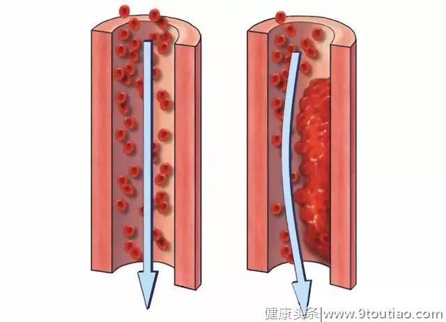 三大院士呼吁：99%的血栓无征兆，记住一个字，一生无栓