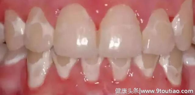 什么，牙齿也有“白化病”？怎么办，会不会危及生命？