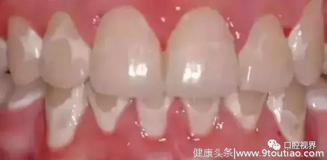 什么，牙齿也有“白化病”？怎么治？