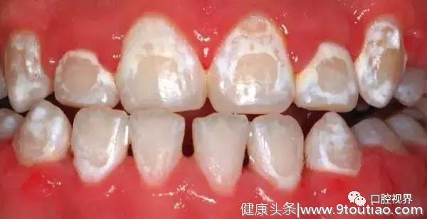 什么，牙齿也有“白化病”？怎么治？