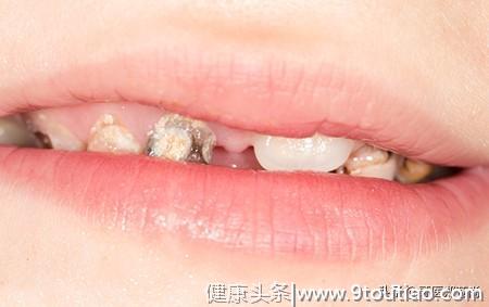生活中哪些因素会导致孩子蛀牙？患者5岁有两颗轻度蛀牙