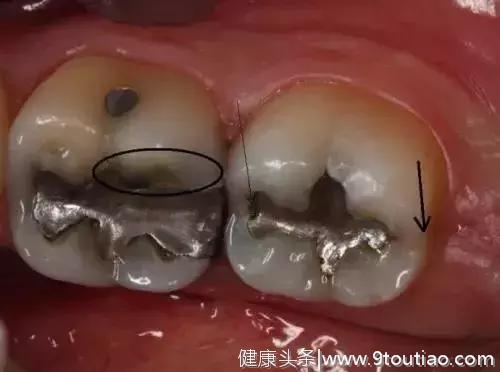 原来牙齿能让冰毒原形毕露！牙医：发现这种牙况特征请小心远离