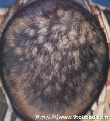 各种类型的脱发如何判断？怎样对症治疗？