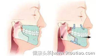 你听说过吗？其实正颌手术还有这种用处