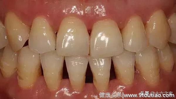 牙齿上的“黑三角”是什么？