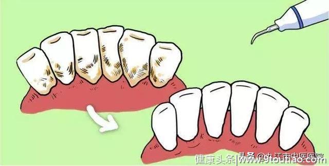 健康科普︱敲黑板！划重点啦！“洗牙”对牙齿健康很重要！