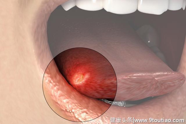 你有口腔溃疡，我有一个妙方，拿走不谢