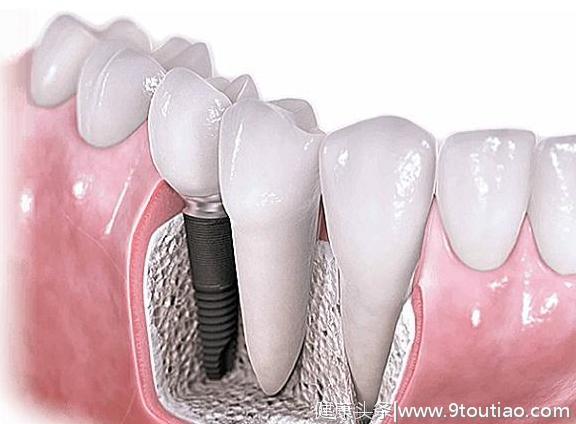 打算种牙？一定要看完这篇文章再决定