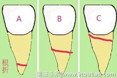 打算种牙？一定要看完这篇文章再决定