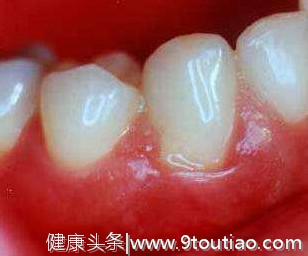 你的牙齿健康吗？90%的中国人患有口腔疾病