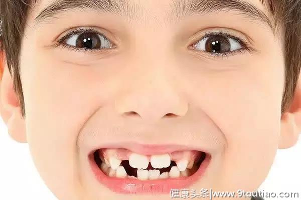 换牙后，孩子的门牙变成「大板牙」怎么办