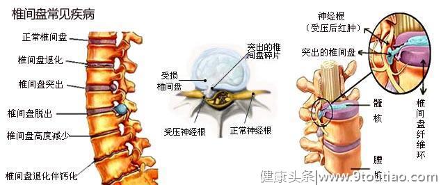 辟谣：腰间盘有问题，腰疼的直不起来，在家练“小燕飞”能缓解？