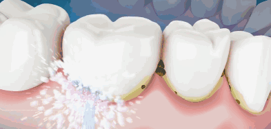 口臭、牙斑菌问题都消失！用它一冲，牙齿缝隙90%脏东西全清掉