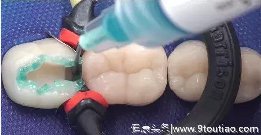 牙齿明明只烂了一半！为什么牙医却说不能补牙？