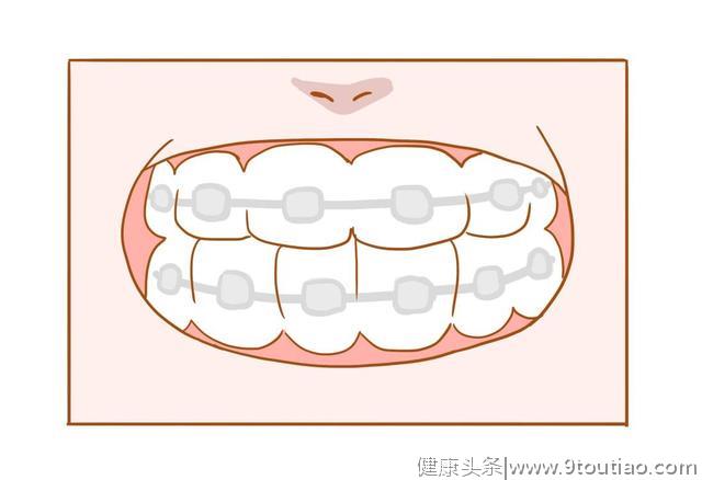 牙齿矫正需要两年的时间，是为什么呢？你知道吗？