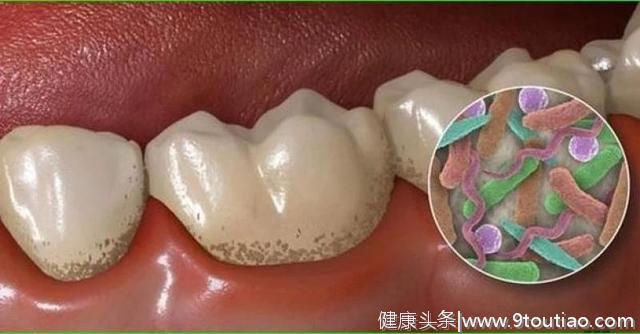 牙齿上的细菌高达300种，怎样才能远离牙病？用这两招