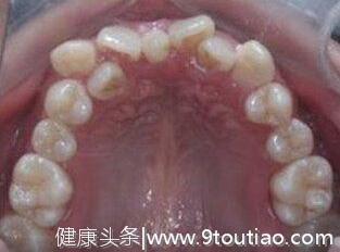 儿童牙医詹磊：家长关注这几个点就可以有效预防儿童口腔问题！