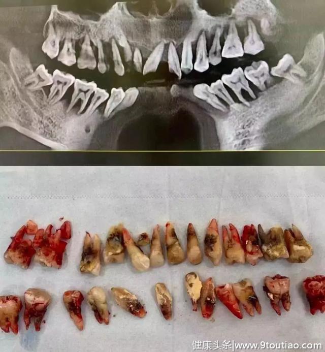 你的牙齿上有黑点、黑线吗？可能已经烂了个大黑洞......