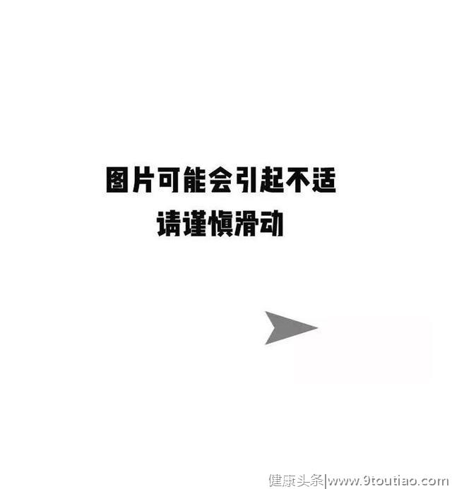 你的牙齿上有黑点、黑线吗？可能已经烂了个大黑洞......