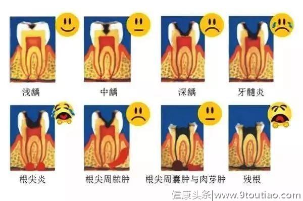 你的牙齿上有黑点、黑线吗？可能已经烂了个大黑洞......