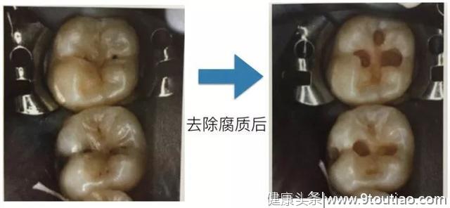 你的牙齿上有黑点、黑线吗？可能已经烂了个大黑洞......