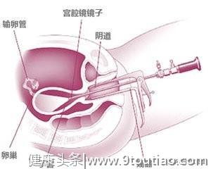 剖宫产后B超显示疤痕处缺口，吃什么药能治好？