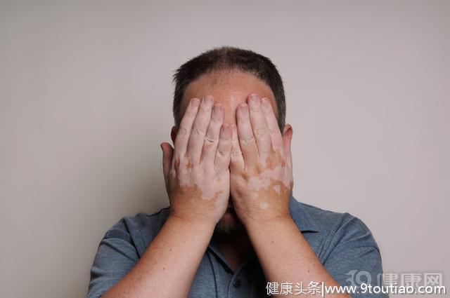 白癜风会遗传给孩子吗？和患者接触会传染吗？答案在这里！